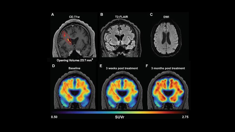 MRI and PET scans of an Alzheimer’s patient receiving FUS in a small region of the brain 