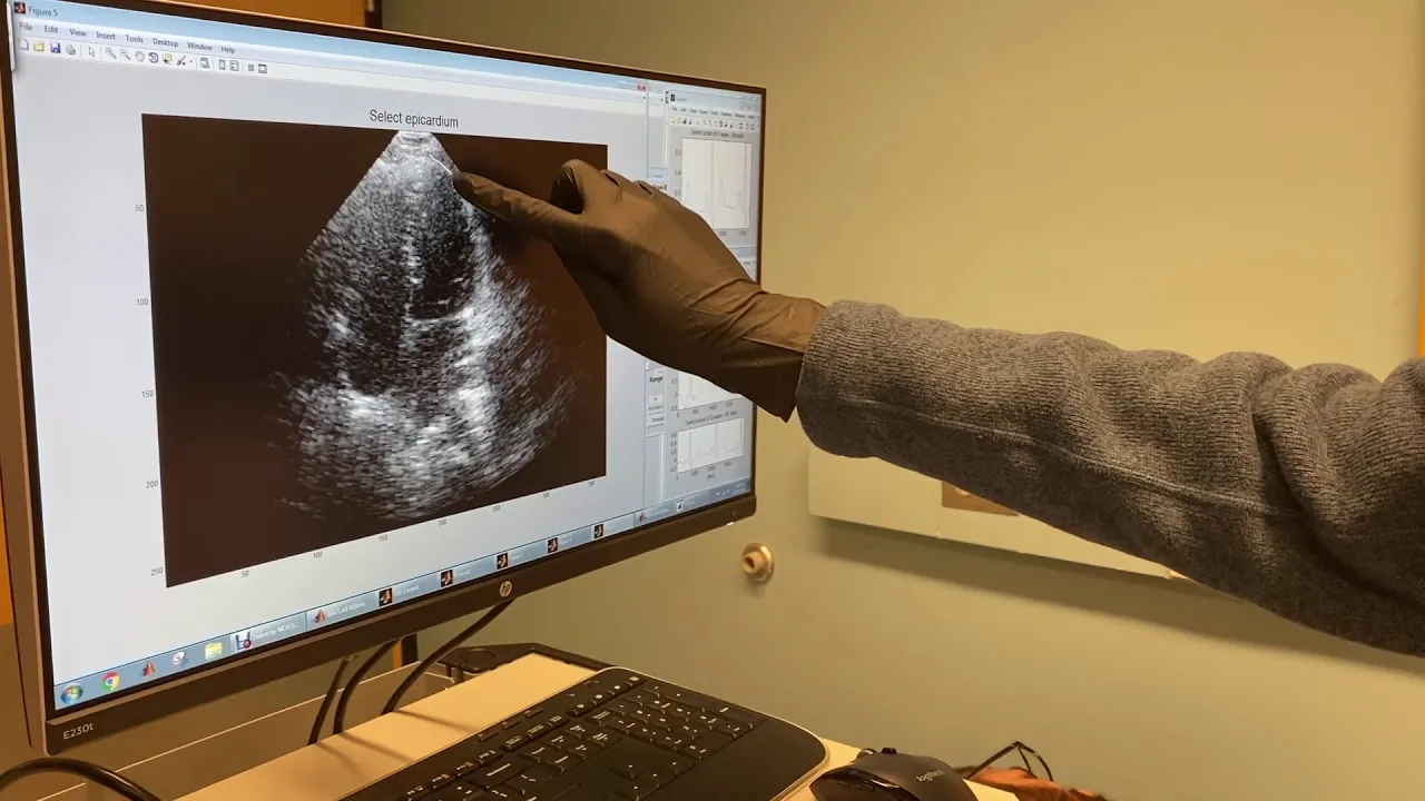Clinical demonstration of 3D arrhythmia mapping using Electromechanical Wave Imagin