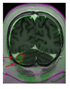 MRI of the blood-brain barrier opening in a diffuse midline glioma patient using the focused ultrasound system; In green indicated by a red arrow shows the volume of opening at 2.44 cm3