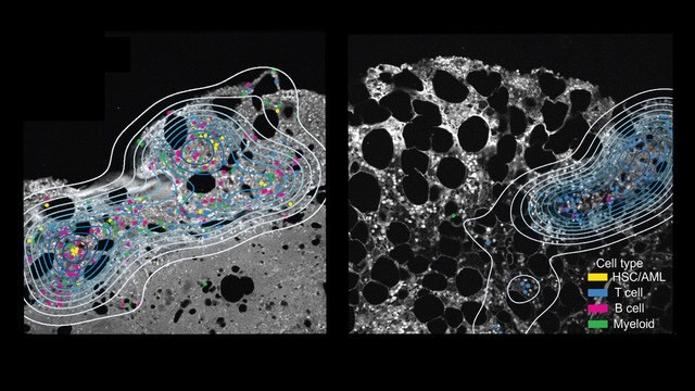Cell types detected in the bone marrow of a responder patient pre-treatment (left) and post-treatment (right). Contour lines mark cell groups with similar spatial neighborhoods, highlighting concentrated regions of diverse and interacting immune cells present pre-treatment (left) and an increase in numbers of T cells with treatment (right).