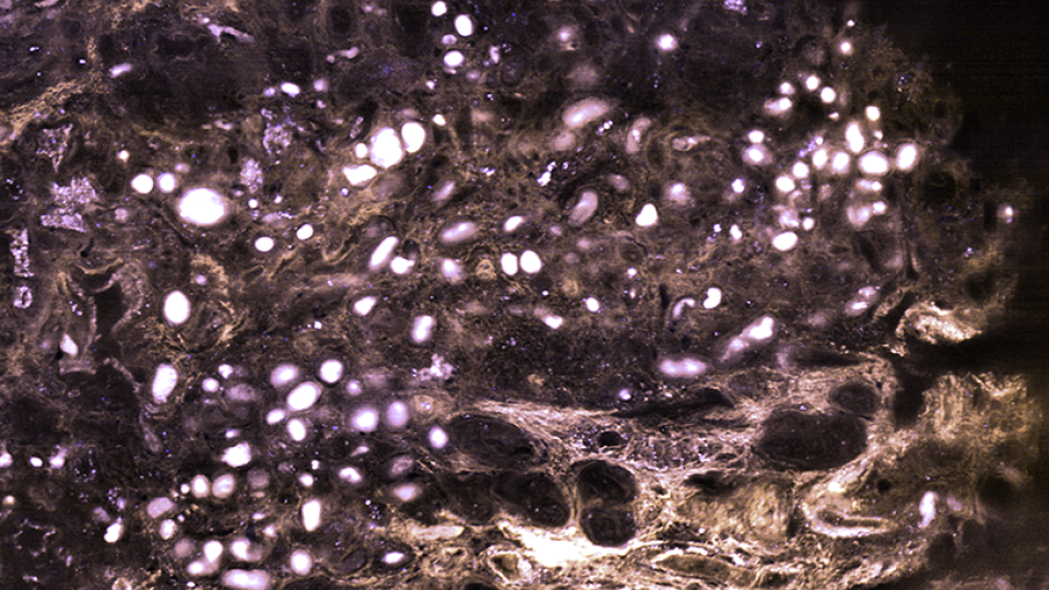 MediSCAPE is a high-speed 3D microscope capable of capturing images of tissue structures that could guide surgeons to navigate tumors and their boundaries without needing to remove tissues and wait for pathology results.