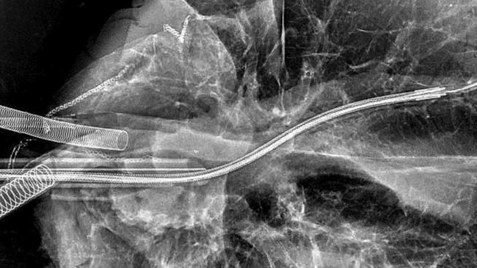 An ultrathin catheter inside a lung