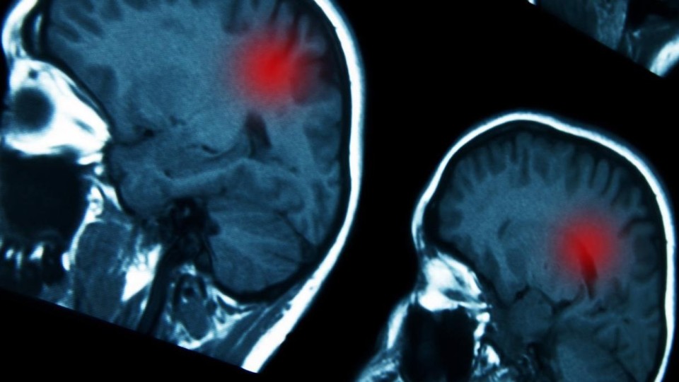 images of brain scans showing a highlighted spot in read