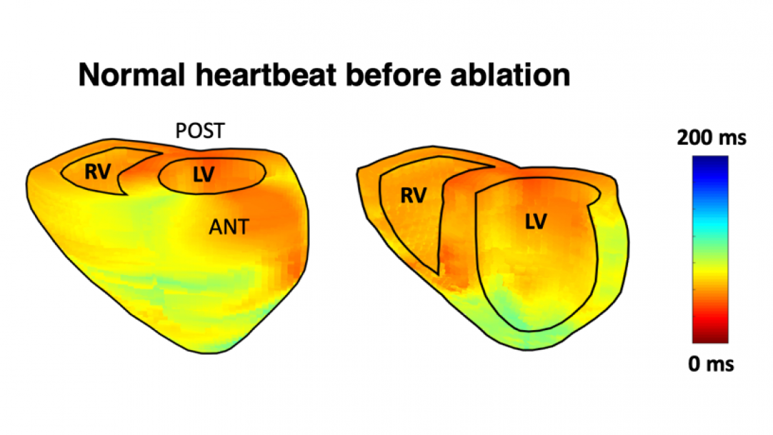 Electromechanical wave imaging (EWI) activation map