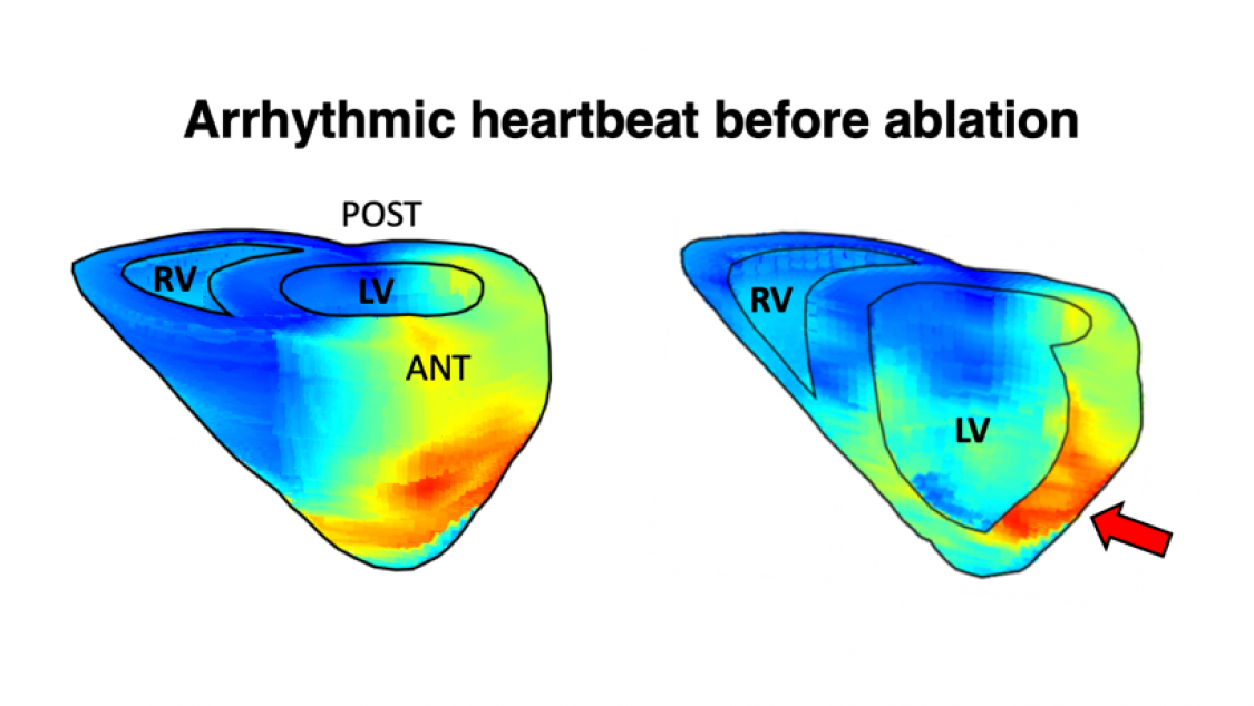 Electromechanical wave imaging (EWI) activation maps