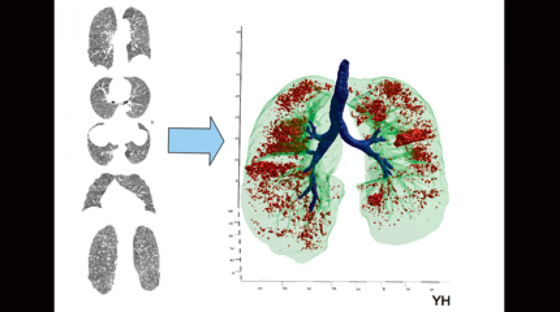 A chart of lungs