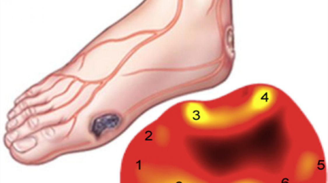 A diagram of a foot