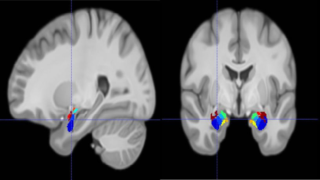Magnetic resonance imaging depicting the location of a recording electrode in a subregion of the amygdala (colored regions). Credit: Salman Qasim/Columbia Engineering.