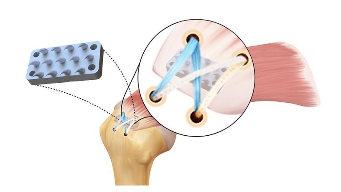 illustration of rotator cuff device