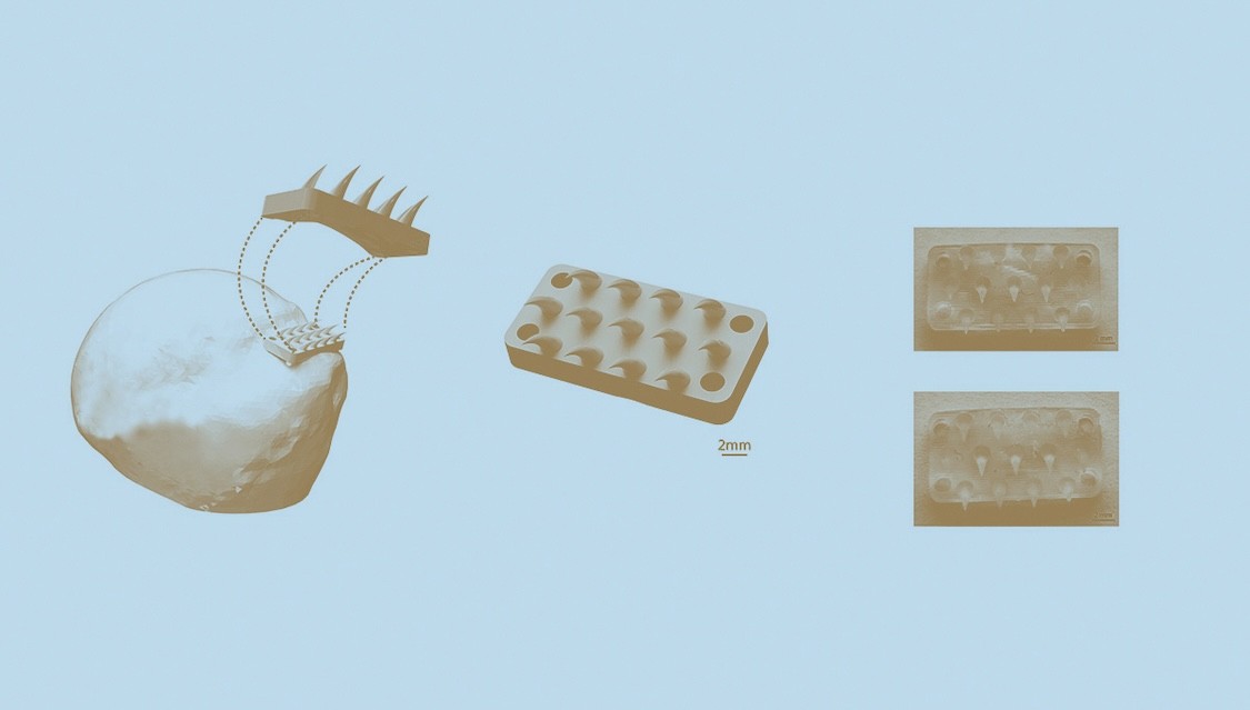 The python tooth-inspired between tendon a bone significantly enhances standard rotator cuff repair