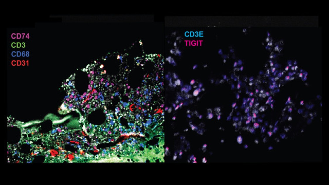 Fluorescence imaging of specific proteins using the CODEX technology in a responder patient (left) and a nonresponder patient (right). In responder sample pre-treatment (left) we see fluorescence from markers denoting different cell types. In contrast, in non responder sample post-treatment (right) we see high overlap of CD3E and TIGIT, suggestive of T cell exhaustion.