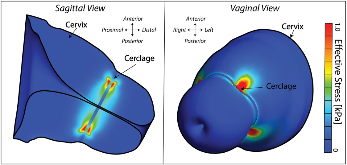 This digital twin simulates how the device affects cervical tissue, revealing areas of stress and potential risk of laceration.