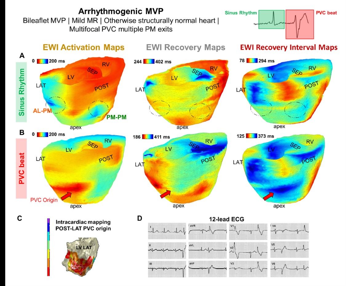 Figure showing electromechanical wave imaging (EWI) maps of a 22-year-old female patient with mitral valve prolapse, comparing heart activation patterns during normal sinus rhythm and an abnormal PVC heartbeat, alongside intracardiac mapping and a 12-lead ECG.