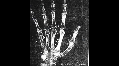 An X-Ray of a hand